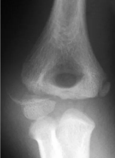 Gambar 9. Gambaran Radiologis Fraktur Kondilus Lateral 