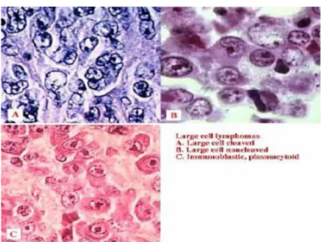 Gambar 2. Large cell Lymphoma 