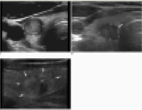 Gambar 4. Gambaran USG dari tepi nodul tiroid 