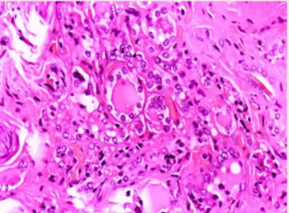 Gambar 10. Jaringan karsinoma tiroid folikuler  Sumber: Santacroce L. Follicular Thyroid Carcinoma 41 