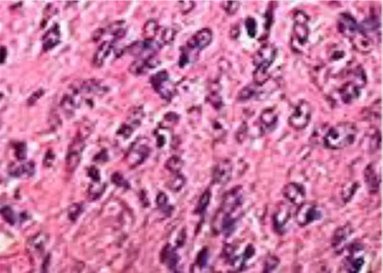 Gambar 12. Jaringan karsinoma anaplastik   Sebagian besar terdiri dari sel spindel  Sumber: Columbia University Medical Center