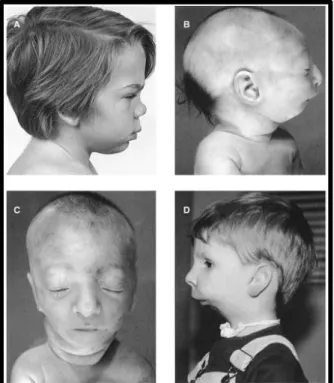 Gambar  2.  Mikrognatia  ringan  pada  anak  laki-laki  usia  12  tahun  dengan  MPS  I-H/I-S  compound  (A),  mikrognati  sedang  pada  infant  dengan  sindrom  cerebro  costomandibular  (B&amp;C),  dan  mikrognatia  berat  terkait  dengan  defek  reduksi