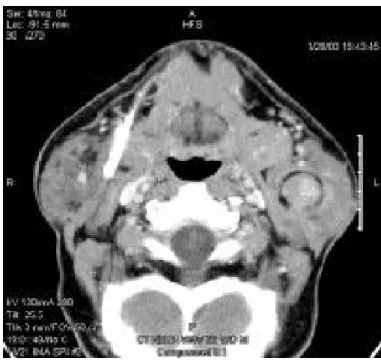 Gambar 4. Tumor Parotis Ganas. Gambar menunjukkan massa berbatas tegas  dalam kelenjar parotis kiri, yang telah terbukti sebagai adenoma pleomorfik 18