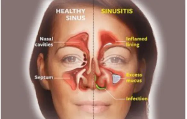 Gambar 2.5 Sinusitis