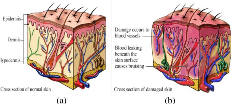 Gambar 12. (a) Kulit normal (b) Memar (kontusio) terjadi ketika pembuluh darah di  bawah  kulit  pecah,  Kebocoran  pembuluh  akan  menyebabkan  warna  biru  kehitaman  pada kulit  yang sering berubah menjadi  warna ungu, merah, kuning, dan hijau  yang  di