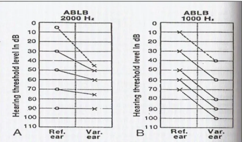 Grafik berupa laddergram, rekrutmen (+) menujukkan tuli kokhlea 
