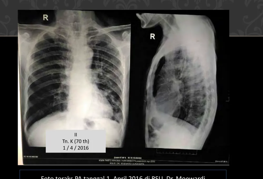 Foto toraks PA tanggal 1  April 2016 di RSU. Dr. Moewardi  Kesan : Multipel nodul paru dan bronkiektasis
