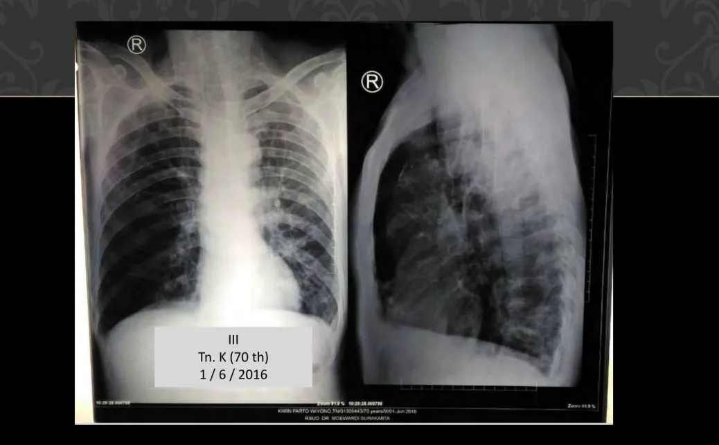 Foto toraks PA tanggal 1 Juni  2016 di RSUD. Sukoharjo  Kesan : Multipel nodul paru dan bronkiektasis  