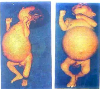 Gambar 5. Foto pasien penderita Hirschsprung berusia 3 hari. Terlihat abdomen  sangat distensi dan pasien kelihatan menderita sekali