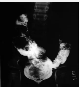 Gambar 15.  Pemeriksaan barium enema pada seorang pria muda dengan penyakit  Hirschsprung tipe segmen pendek