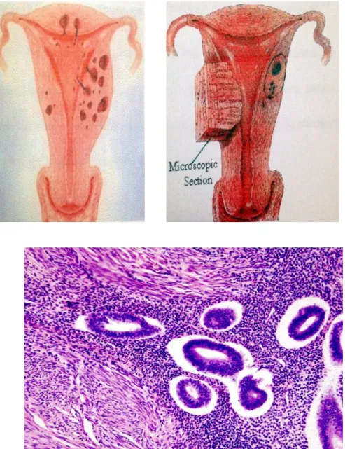 Gambar 2.5 Endometriosis Interna 24