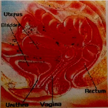 Gambar 2.6 Lokasi Endometriosis Eksterna  26