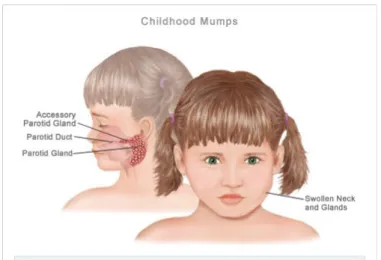 Gambar 2. Gambaran mumps pada anak