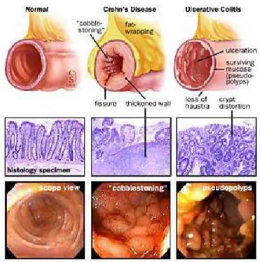 Gambar 4. Colonoscopy colon normal, Chron’s disease, dan colitis ulcerative