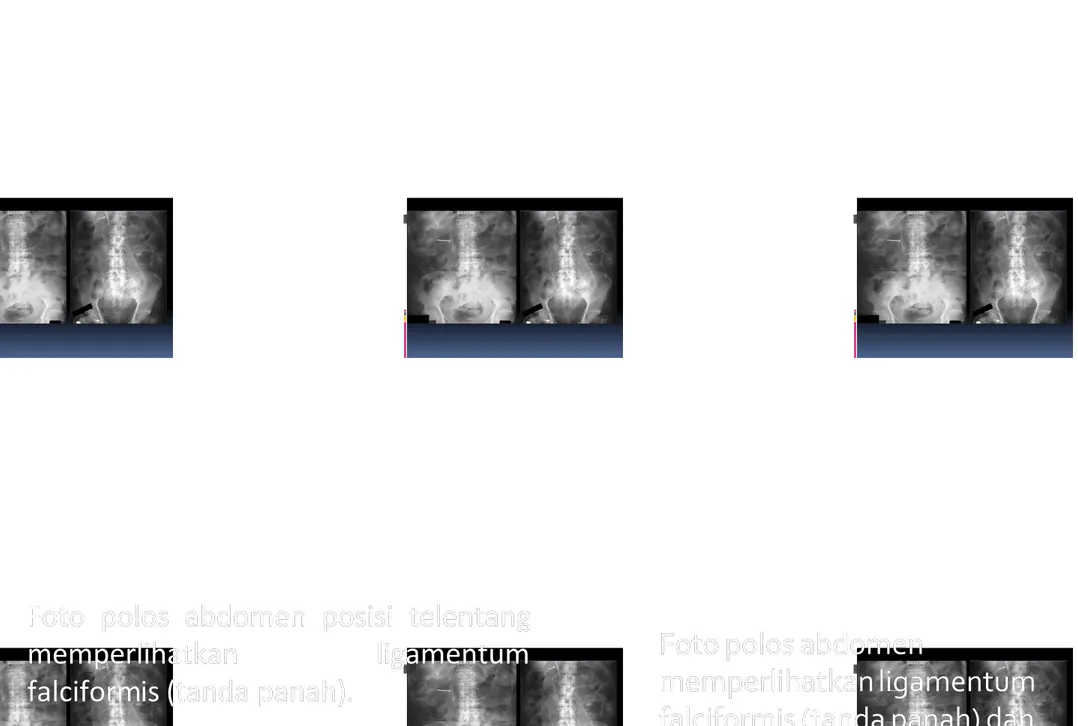 Foto  polos  abdomen  posisi  telentangFoto  polos  abdomen  posisi  telentang memperlihatkan  ligamentummemperlihatkan ligamentum falciform