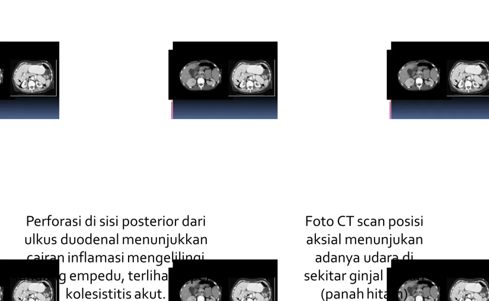 Foto CT scan posisi aksial menunjukan
