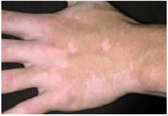 Gambar 3.24  Vitiligo 