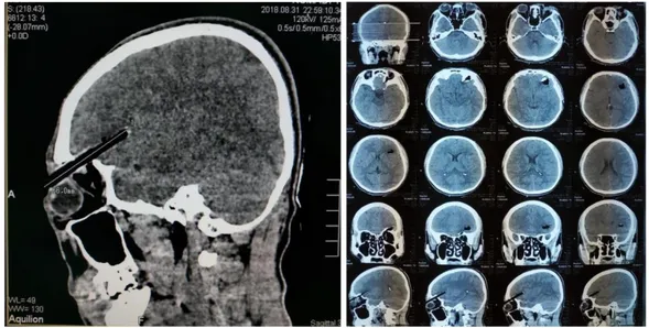 Gambar 2. CT Scan kepala 