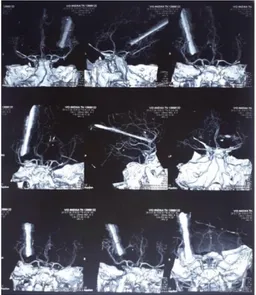 Gambar 6. CT angiografi kepala peluru ikan 