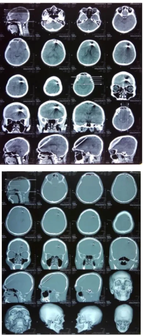 Gambar 7. CT Scan kepala peluru ikan 2 