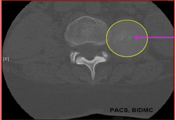 Gambar 5 : CT Scan non kontras vertebra posisi axial : tampak abses pada m. Psoas  kiri (lingkaran kuning ) dengan ditengahnya terdapat kalsifikasi (arah panah) 