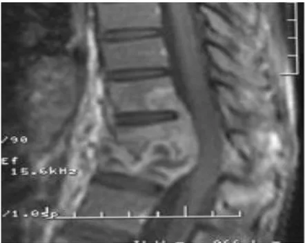 Gambar 7 :  gambar sagital T1 postcontrast menunjukkan destruksi dari dua corpus  vertebra yang berdekatan dengan perluasan ke sumsum tulang, endplate, dan  menghancurkan diskus intervertebralis .Perhatikan adanya kyphosis dan kompresi  tulang belakang pad