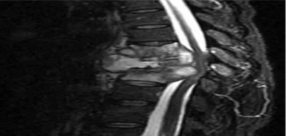 Gambar 8: Modalitas MRI sagittal yang menunjukkan spondilitis extensive pada T8- T8-T10 yang ditandai dengan adanya destruksi korpus vertebra dan diskus  intervertebralis