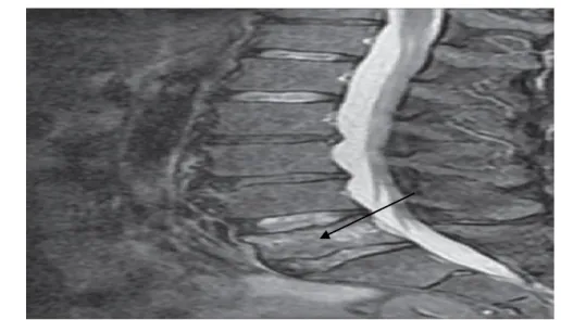 Gambar 11 : Modalitas MRI : Tampak fraktur kompresi L5 yang tidak  melibatkan diskus intervertebralis tidak seperti pada spondilitis TB