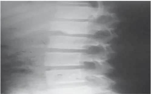 Gambar 12 : Tampak osteolitik pada L1 bagian inferior, tidak adanya penipisan  korpus vertebrae dan tidak terbentuk abses paraspinal seperti pada spondilitis TB 