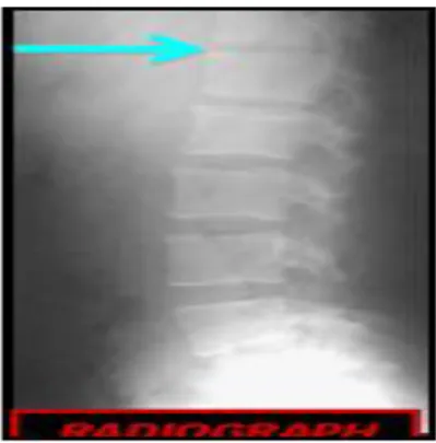 Gambar 2 : Gambaran radiologis pada foto polos vertebra posisi lateral  menunjukkan adanya destruksi pada diskus intervertebralis(arah panah biru)pada 