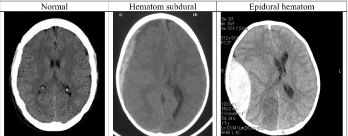 Gambar 5 Perbandingan gambaran CT scan pada orang normal, SDH, dan EDH Pada   fase   kronik   lesi   subdural   menjadi   hipodens   dan   sangat   mudah   dilihat   pada gambaran CT tanpa kontras