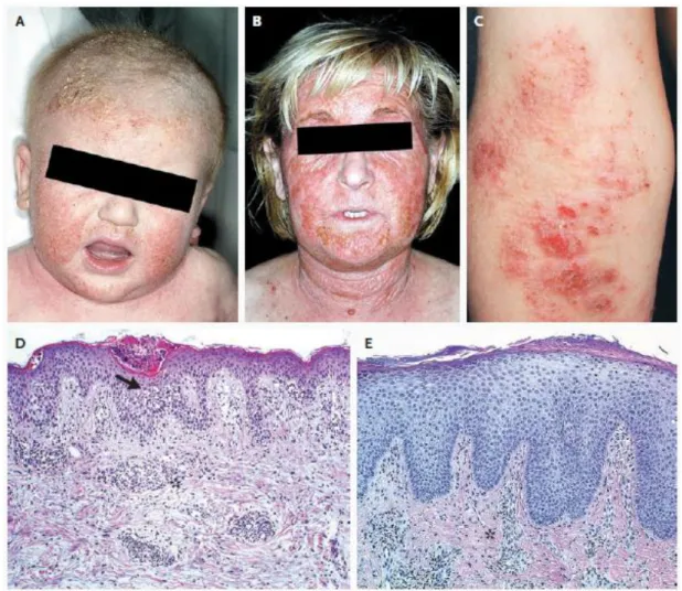 Gambar 1. Aspek Klinis, Histologis, dan Imunohistokima Dermatitis Atopi 