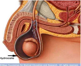 Gambar 5 :   Penumpukan   cairan   antara   lapisan   parietalis   dan   visceral   tunika  vaginalis testis