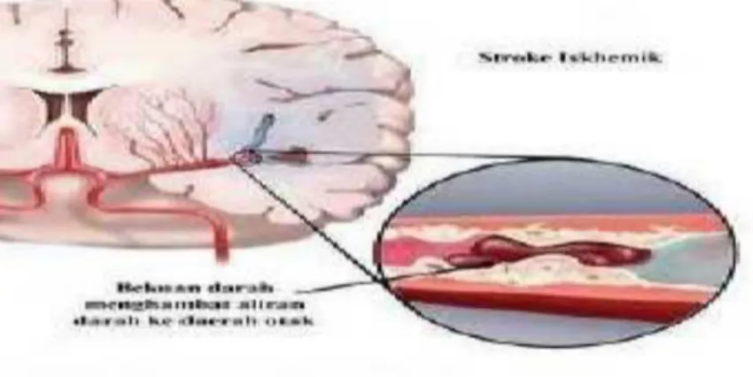 Gambar 5. Stroke trombosis
