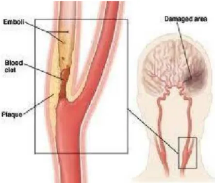 Gambar 6. Stroke emboli