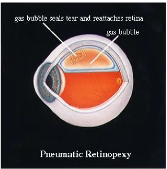 Gambar 8. Retinopeksi pneumatic