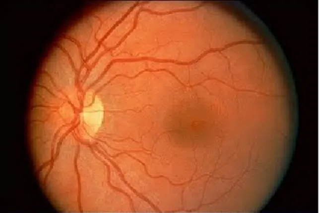 Gambar 3. Gambaran retina normal 