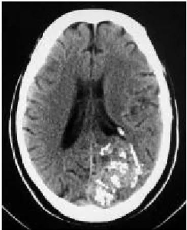 Gambar 5. CT   scan   kepala   menunjukan   malformasi   arterivena   pada  lobus   oksipital   kiri   dengan   multiple   flebolit   yang  terkalsifikasi   dan  dan   banyak   hiperatenuasi  vaskular  channels.