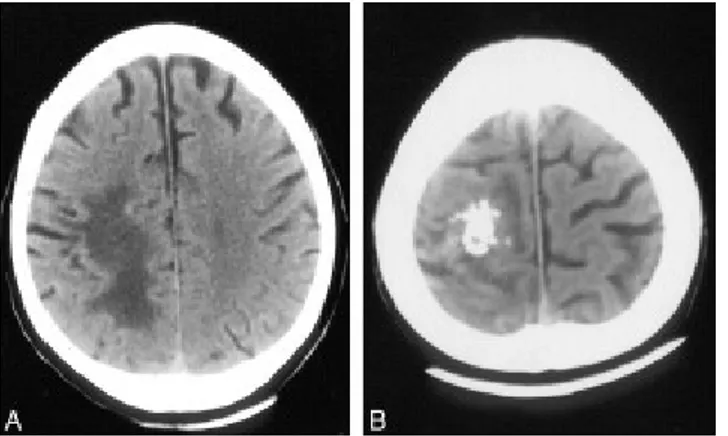 Gambar 7. CT   scan   awal   menunjukkan   lesi   berukuran   1,5   cm   yang  berlobulasi   dan   kalsifikasi   di   sentral   yang   dikelilingi  substansi hipoatenuasi.