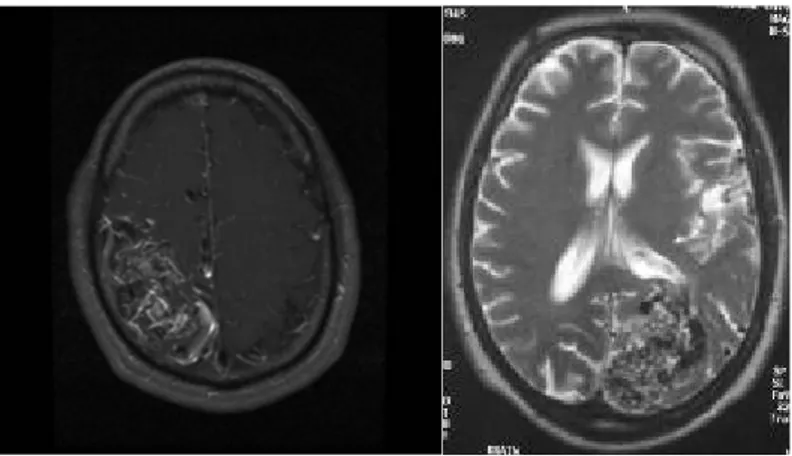 Gambar 12. Gambaran Malformasi arterivena pada otak dengan metode  MRI.