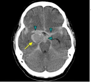 Gambar 15. Panah kuning menunjukkan  lokasi giant aneurysm yang  ruptur   disertai   dengan  trombus   yang   berada   di  dalam kantong aneurisma.