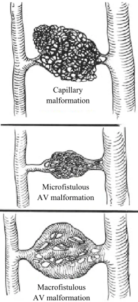 Gambar 1. Malformasi   kapiler,   mikrofistul   malformasi   arteri   vena,   dan  makrofistul arteri vena