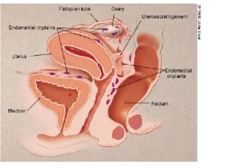 Gambar 2. Menstruasi Mundur dan Transplantasi Sumber : http://ezcobar.com/dokter-      online/dokter15/index.php