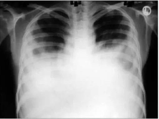 Gambar 4. Efusi pleura bilateral