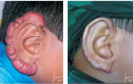 Gambar 4. Kiri: Parut hipertrofik