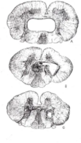 Gambar 2.6 Syringomyelia