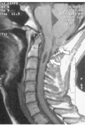 Gambar 2.9 MRI Syringomyelia yang menyertai Malformasi Chiari I Pemeriksaan lain yang dapat dilakukan adalah 1,,3,7  :