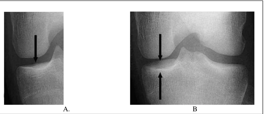 Gambar 2.2:dari tepi anterior dan posterior plateau tibia. (B) Contoh gambarangambarankurang baik dari plateau tibia medialis, dimana terdapat separasi tepi anterior dan Alignment plateau tibia medialis pada radiografi lutut