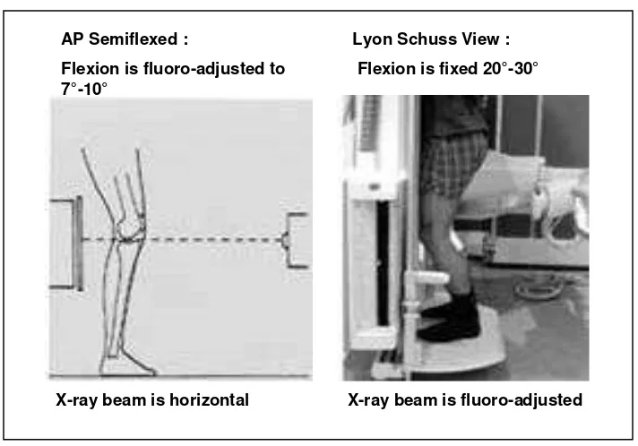 Gambar 2.3 : Protokol radiografi lutut dengan bantuan fluoroskopi (A) Protokolsemifleksi AP, (B) Protokol Lyon Schuss (Vignon, 2004)