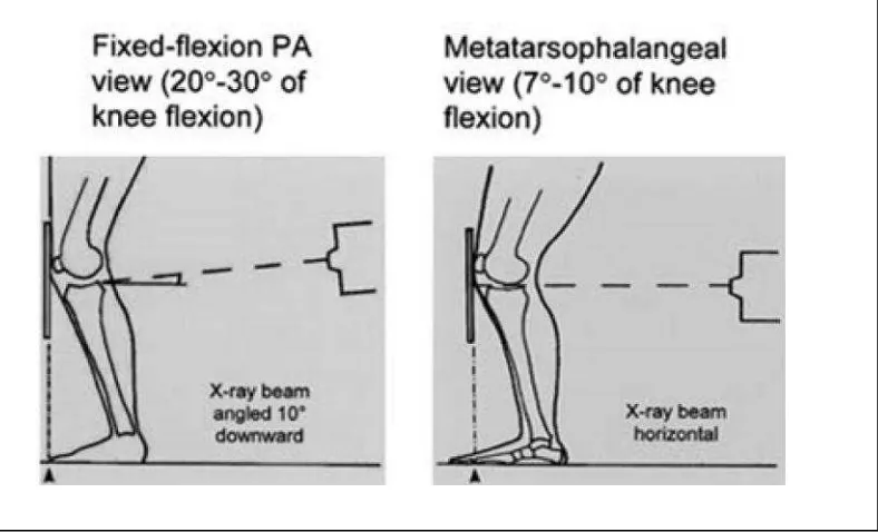 Gambar 2.4 : Protokol radiografi lutut tanpa menggunakan fluroskopi.(A) Protokol fixed flexion , (B) Protokol metatarsofalang (Vignon, 2004).